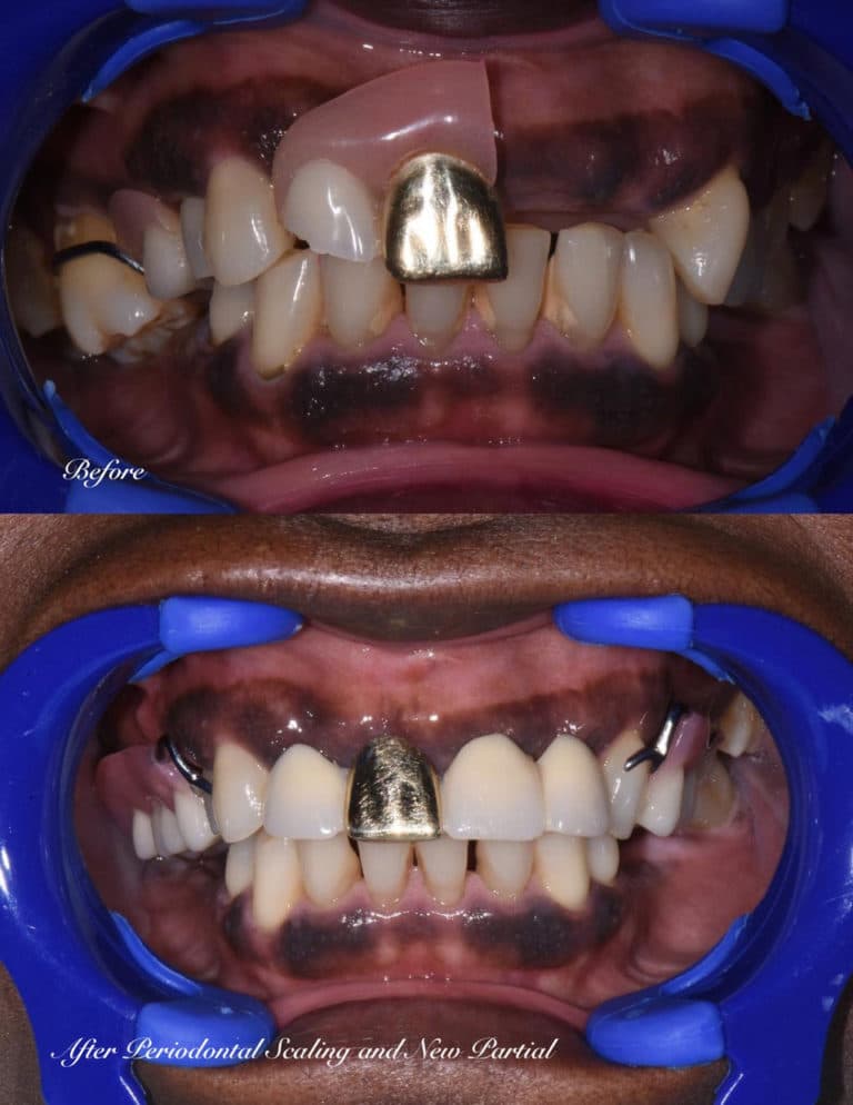 Before and after dental treatment Dental Solutions of Mississippi dentist in Canton MS Dr. Ruth Roach Morgan Dr. Jessica Morgan