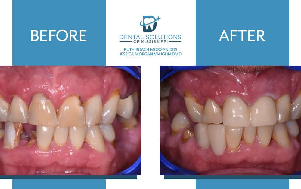 Before and after dental treatment Dental Solutions of Mississippi dentist in Canton MS Dr. Ruth Roach Morgan Dr. Jessica Morgan