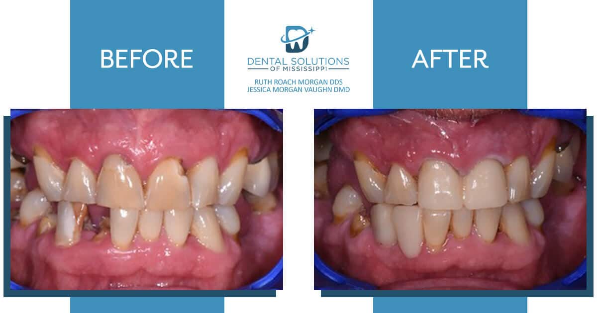 Before and after dental treatment Dental Solutions of Mississippi dentist in Canton MS Dr. Ruth Roach Morgan Dr. Jessica Morgan