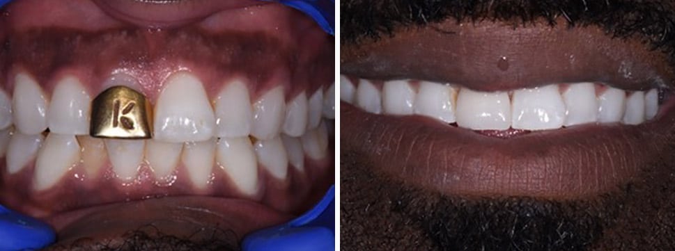 Before and after dental treatment Smile Gallery Dental Solutions of Mississippi dentist in Canton MS Dr. Ruth Roach Morgan Dr. Jessica Morgan