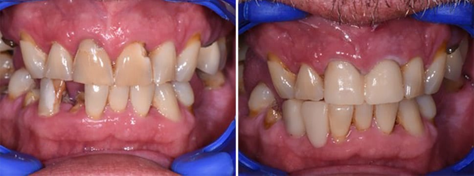 Before and after dental treatment Smile Gallery Dental Solutions of Mississippi dentist in Canton MS Dr. Ruth Roach Morgan Dr. Jessica Morgan