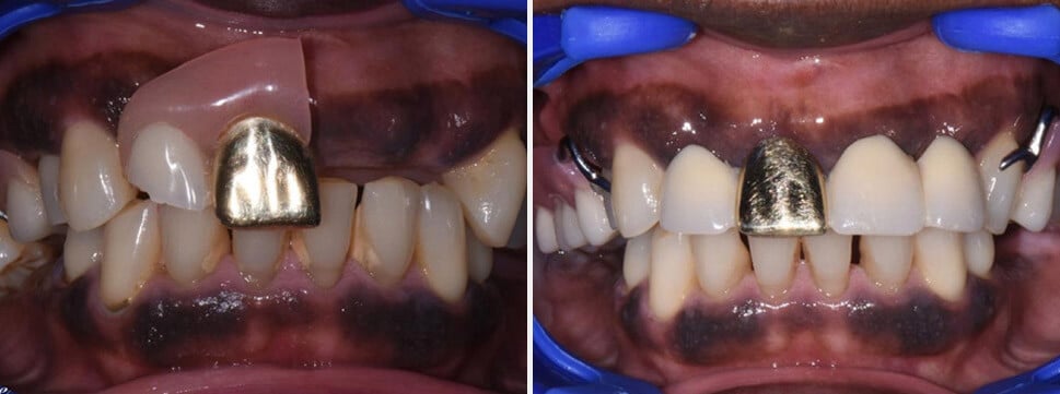 Removable Dentures before and after Dental Solutions of Mississippi dentist in Canton MS Dr. Ruth Roach Morgan Dr. Jessica Morgan