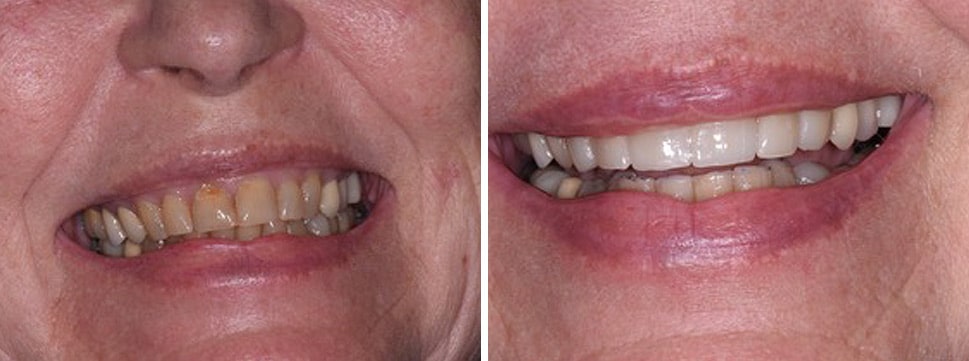 Before and after dental treatment Smile Gallery Dental Solutions of Mississippi dentist in Canton MS Dr. Ruth Roach Morgan Dr. Jessica Morgan