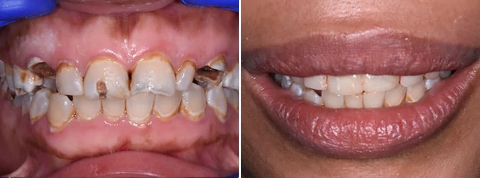 Before and after dental treatment Smile Gallery Dental Solutions of Mississippi dentist in Canton MS Dr. Ruth Roach Morgan Dr. Jessica Morgan