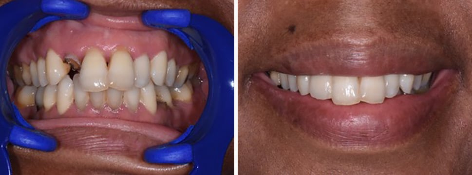 Before and after dental treatment Smile Gallery Dental Solutions of Mississippi dentist in Canton MS Dr. Ruth Roach Morgan Dr. Jessica Morgan