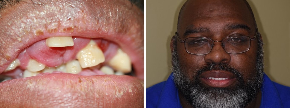 Before and after dental treatment Smile Gallery Dental Solutions of Mississippi dentist in Canton MS Dr. Ruth Roach Morgan Dr. Jessica Morgan