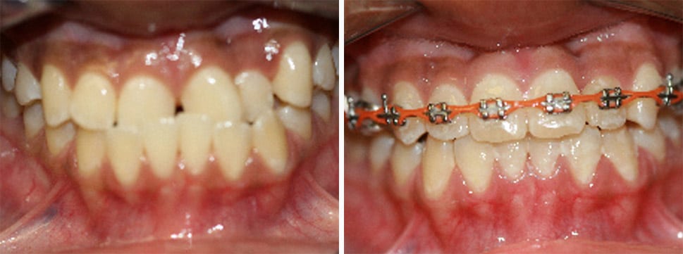 Before and after dental treatment Smile Gallery Dental Solutions of Mississippi dentist in Canton MS Dr. Ruth Roach Morgan Dr. Jessica Morgan