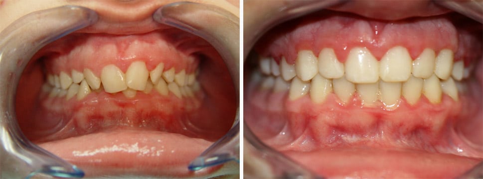 Before and after dental treatment Smile Gallery Dental Solutions of Mississippi dentist in Canton MS Dr. Ruth Roach Morgan Dr. Jessica Morgan