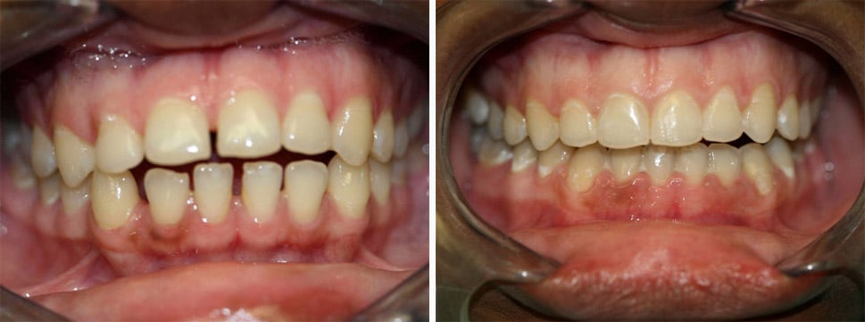 Before and after dental treatment Smile Gallery Dental Solutions of Mississippi dentist in Canton MS Dr. Ruth Roach Morgan Dr. Jessica Morgan