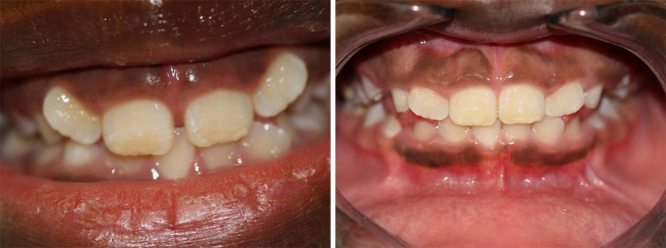 Before and after dental treatment Smile Gallery Dental Solutions of Mississippi dentist in Canton MS Dr. Ruth Roach Morgan Dr. Jessica Morgan